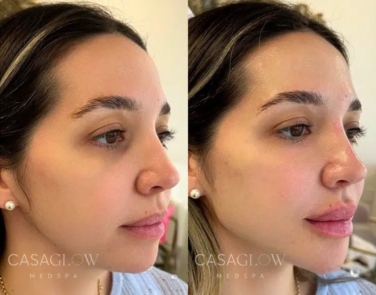 Before Pico Laser